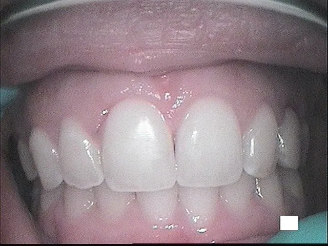 Before, After Crown Lengthening