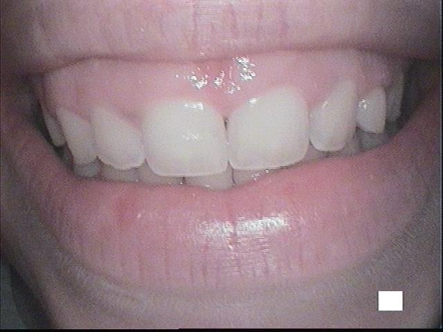 Before, After Crown Lengthening