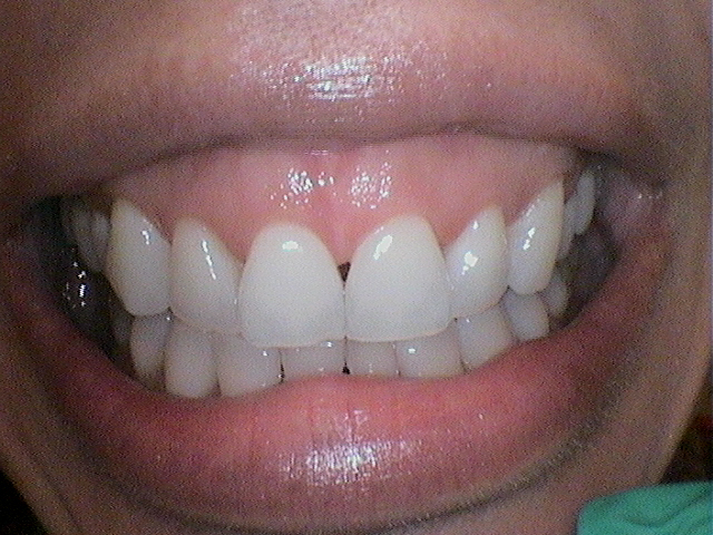 before after lip repo