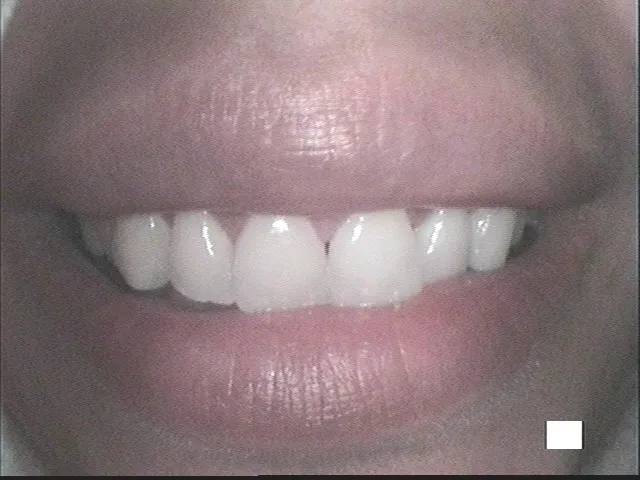 Before, After Lip Repo.2