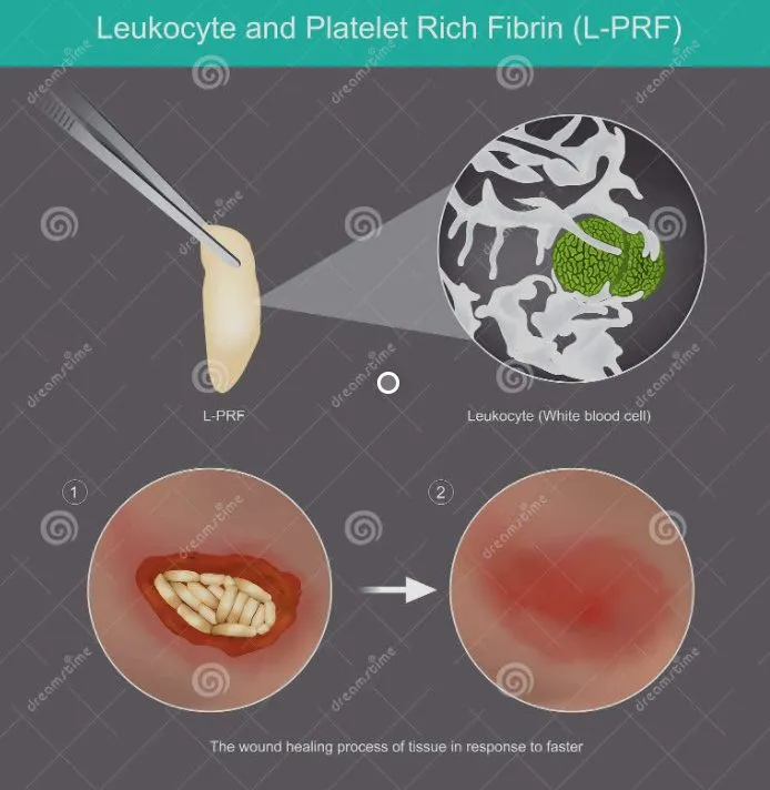 L-PRF image II