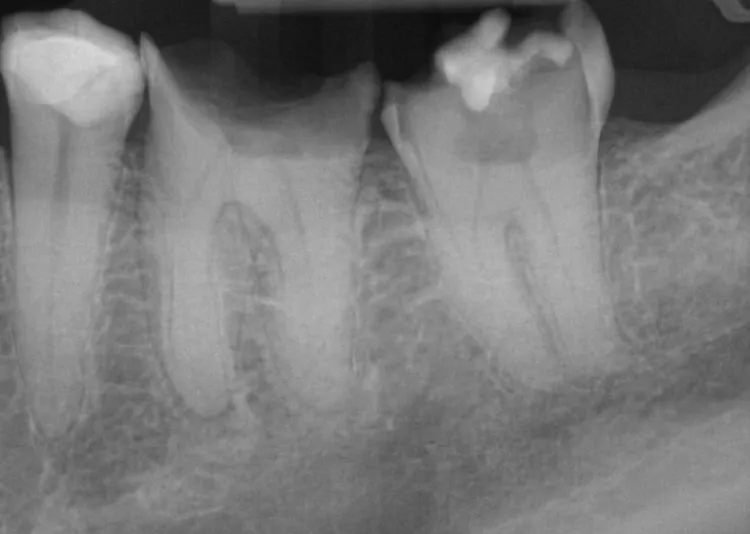 bone grafting before, after
