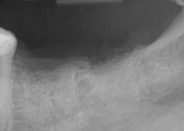 bone grafting before, after