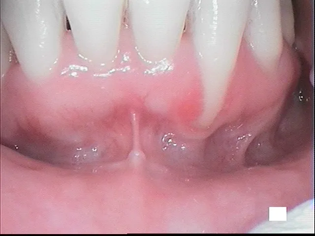 gum grafting before, after