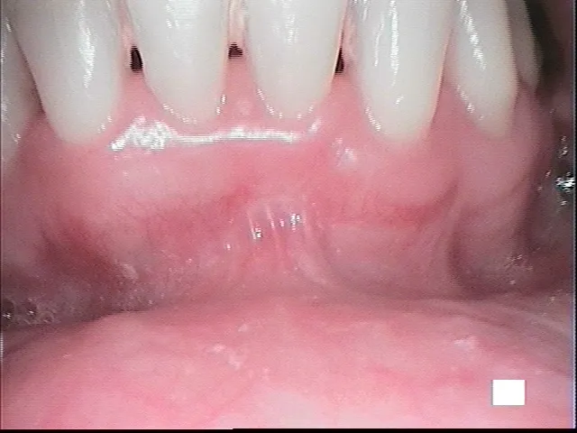 gum grafting before, after